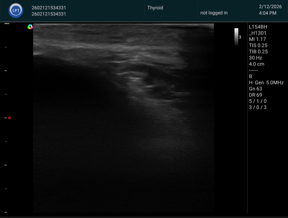 右内側半月板周囲 脂肪体 施術後