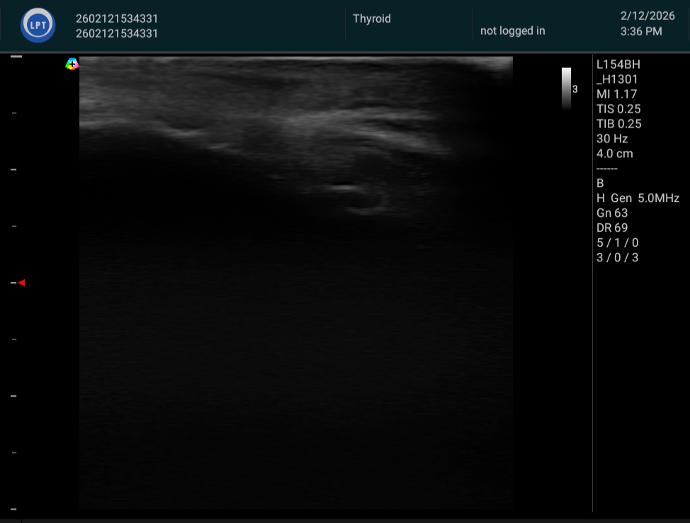 右内側半月板周囲 脂肪体 施術前