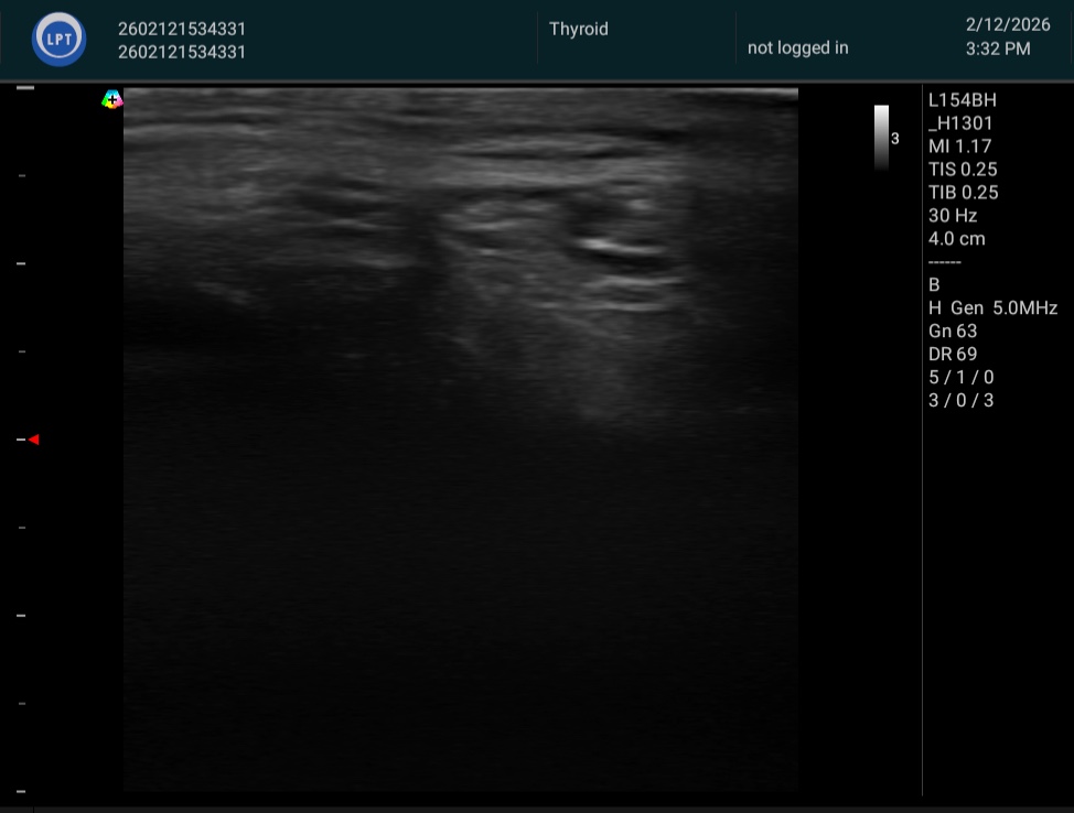 左外側半月板周囲 脂肪体 施術前