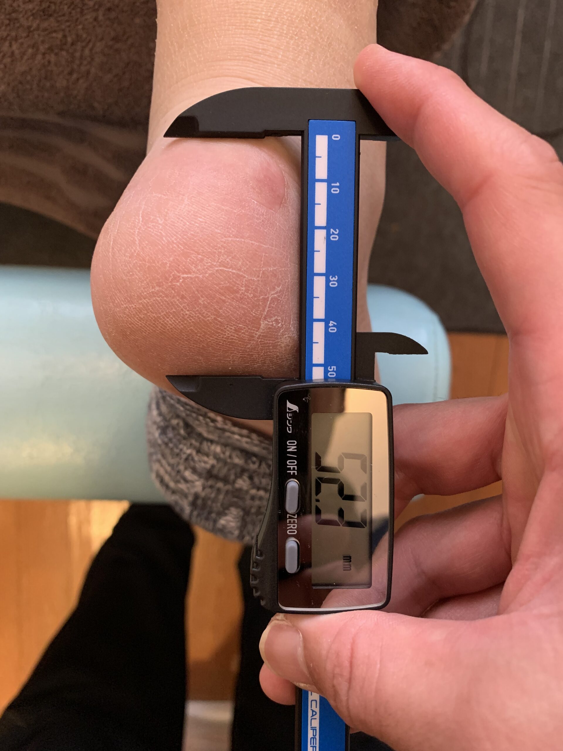 踵骨脂肪体 ノギス計測 施術後