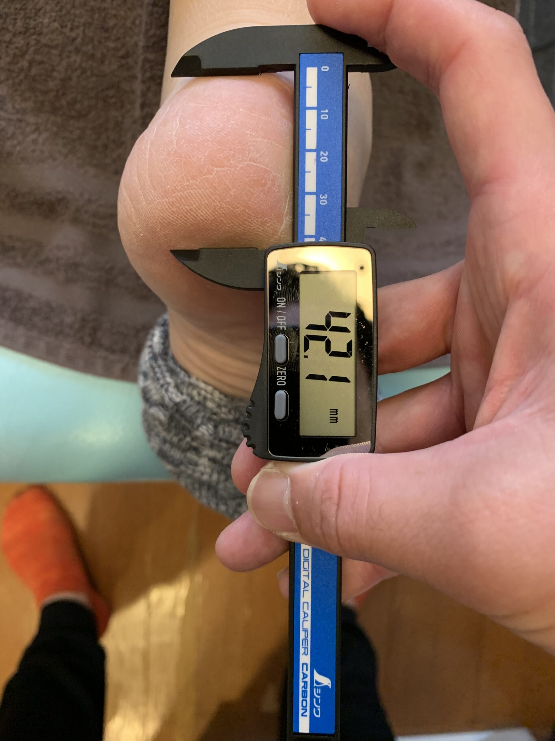 踵骨脂肪体 ノギス計測 施術前