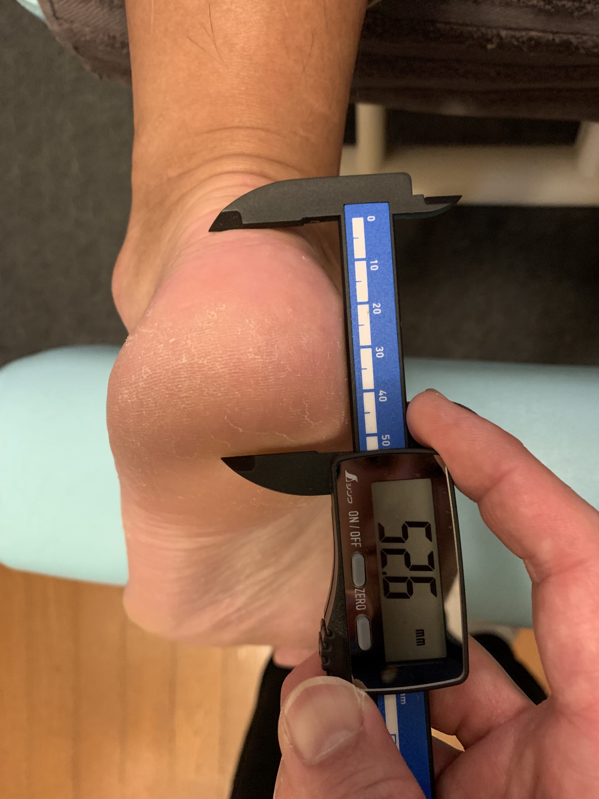 踵骨脂肪体 ノギス計測 施術後