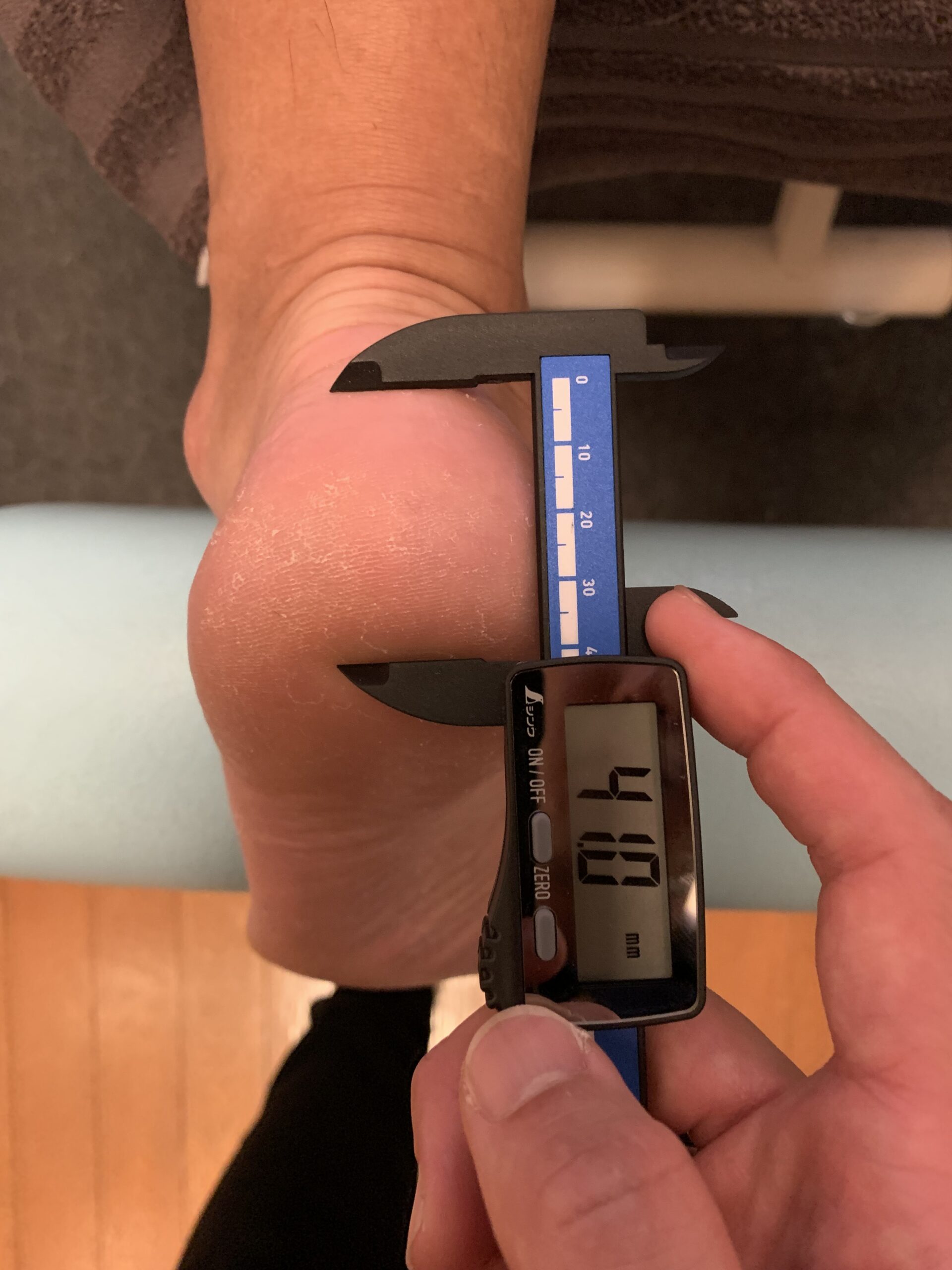 踵骨脂肪体 ノギス計測 施術前